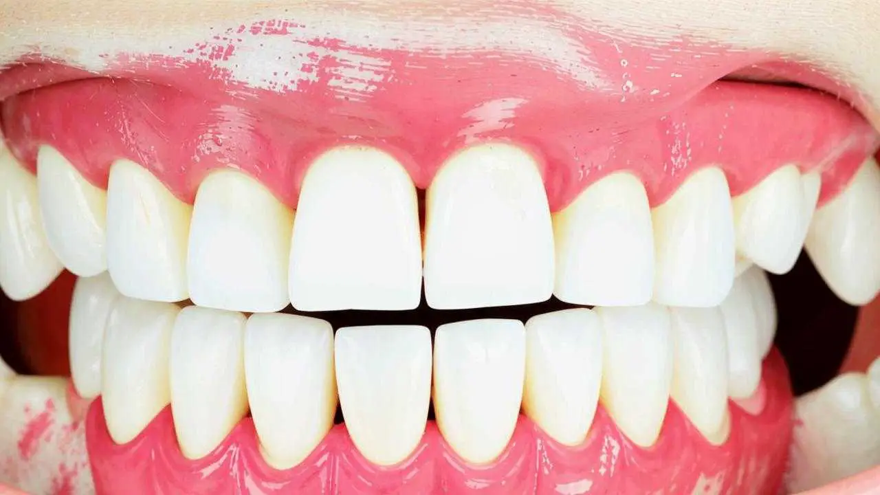 white spots after teeth whitening