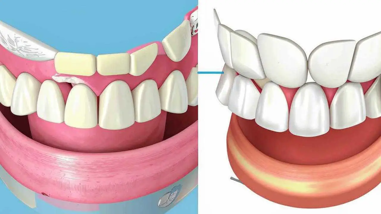 veneer placement