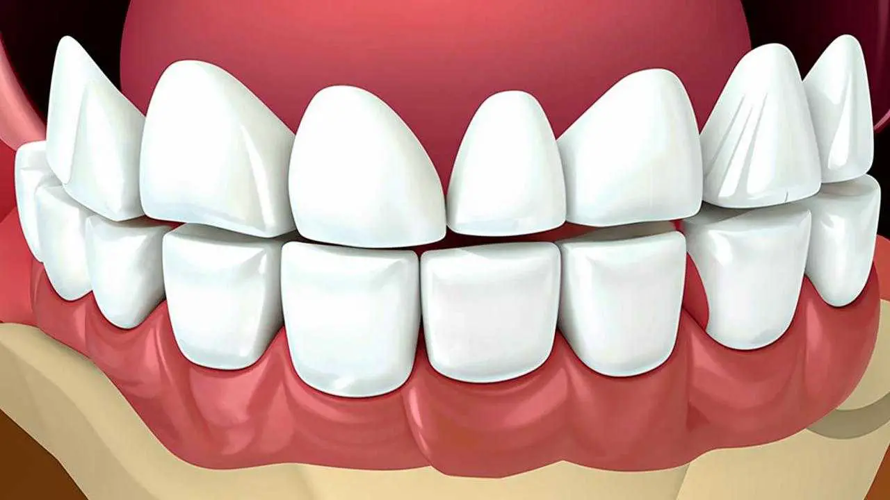 wisdom tooth gingival hood