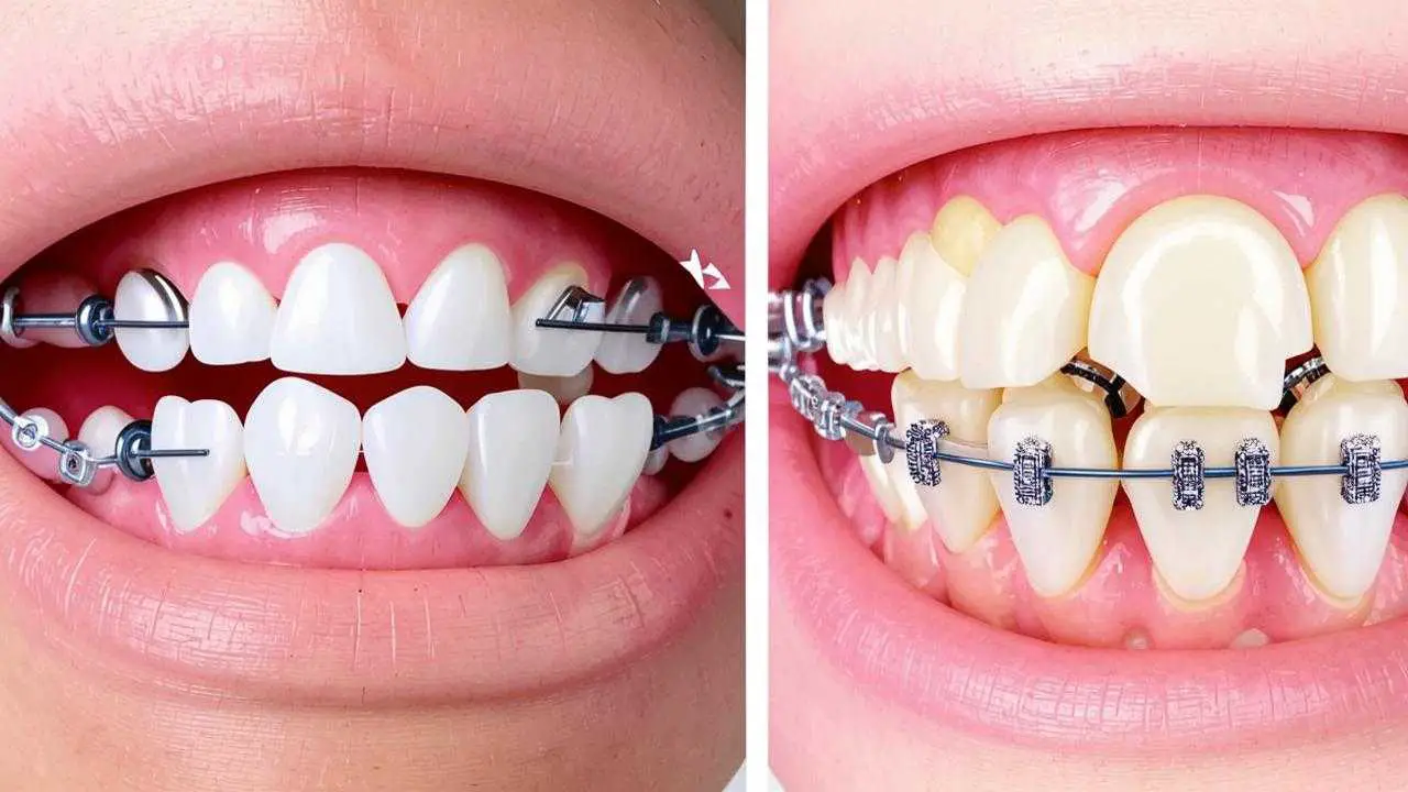 differences between eliners and braces