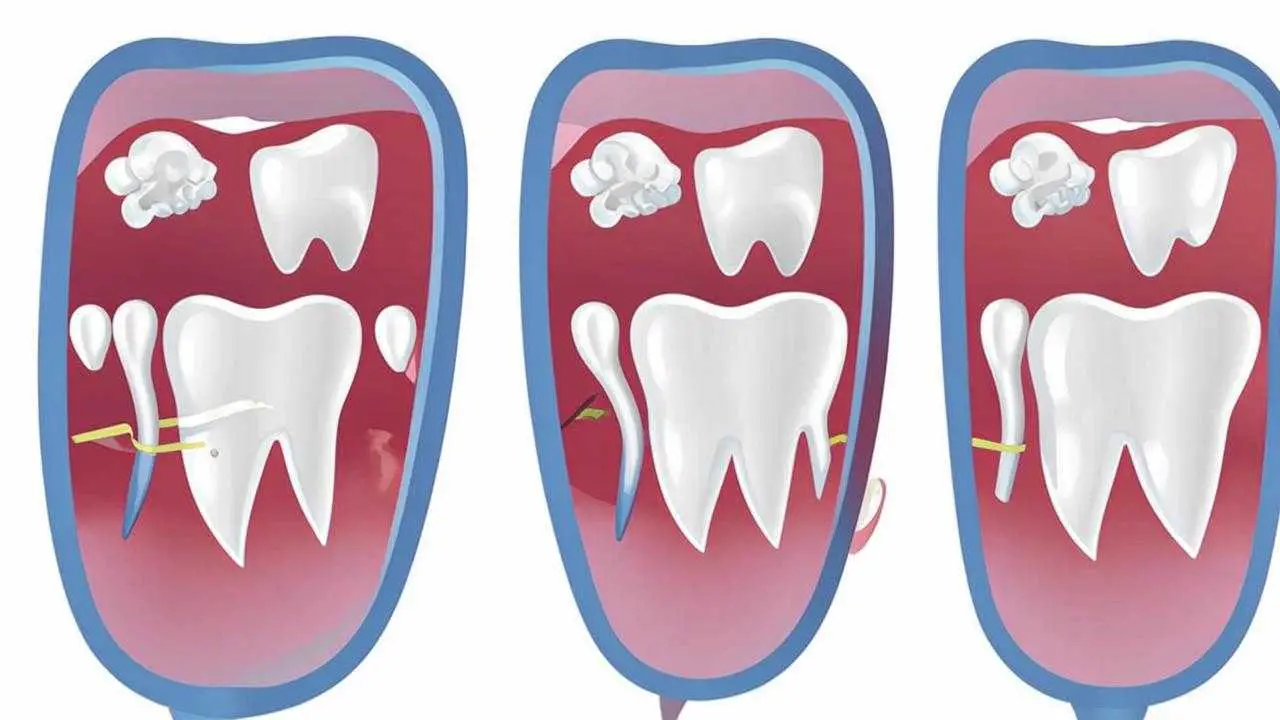 indications for crown placement