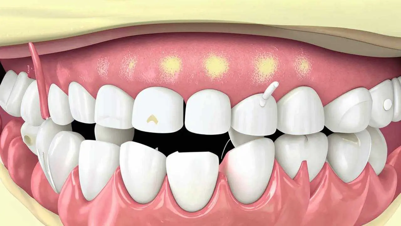 fluorosis diagnosis