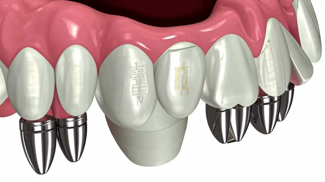 Implant gum shaper placement