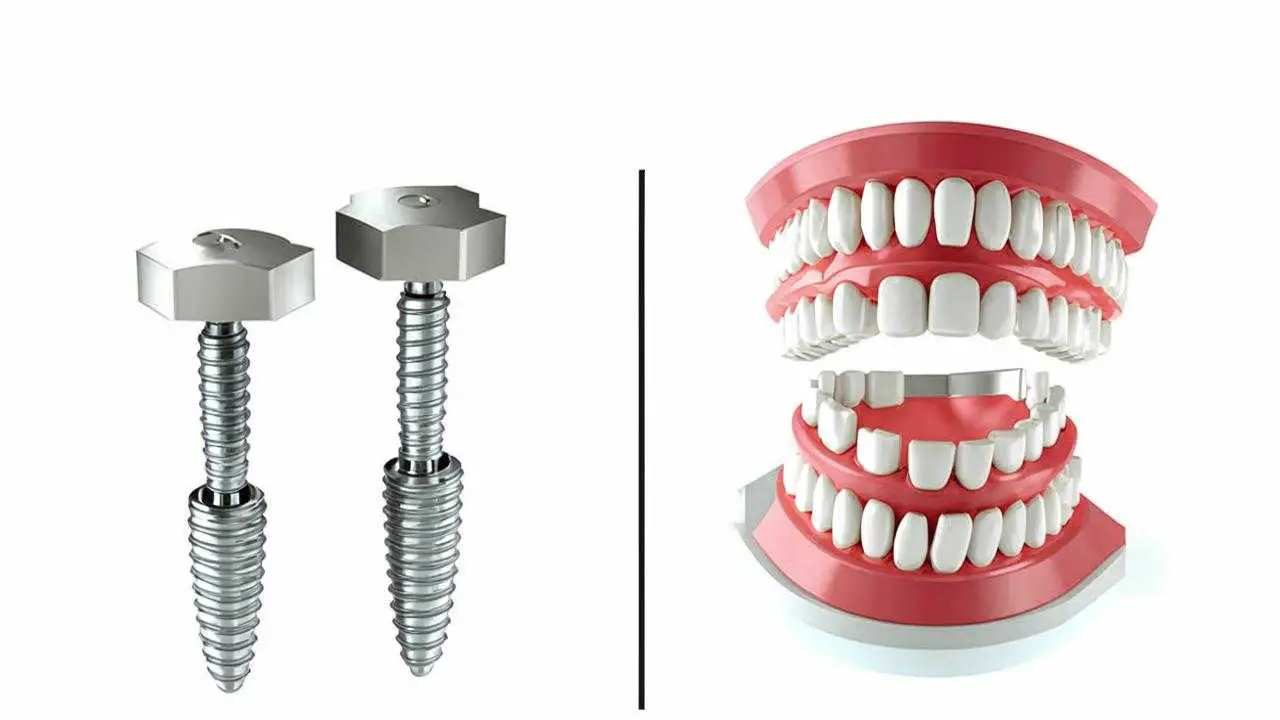 dental implant warranty