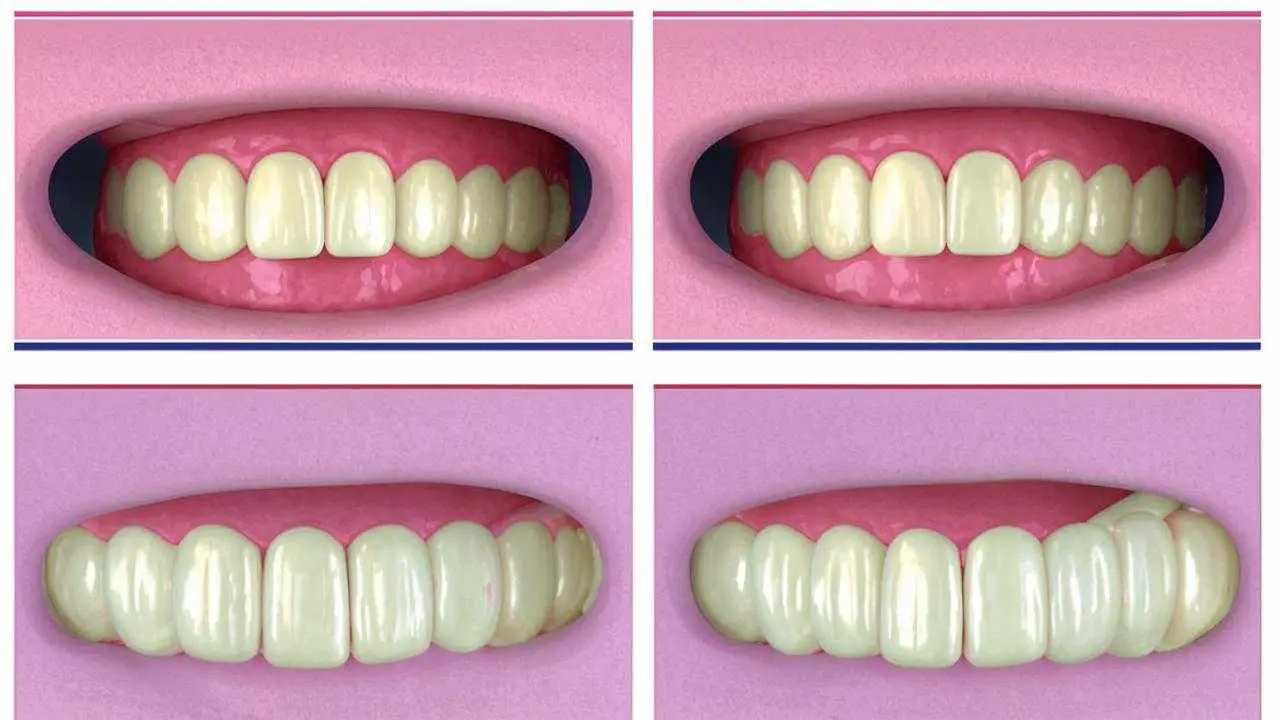 before and after fissure sealing photo