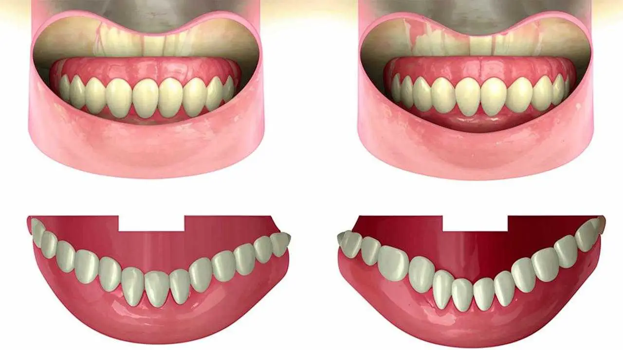 types of gingival hyperplasia