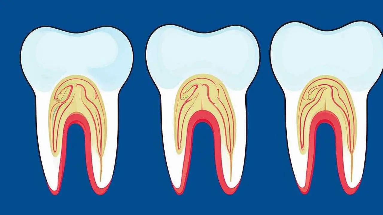 stages of tooth decay