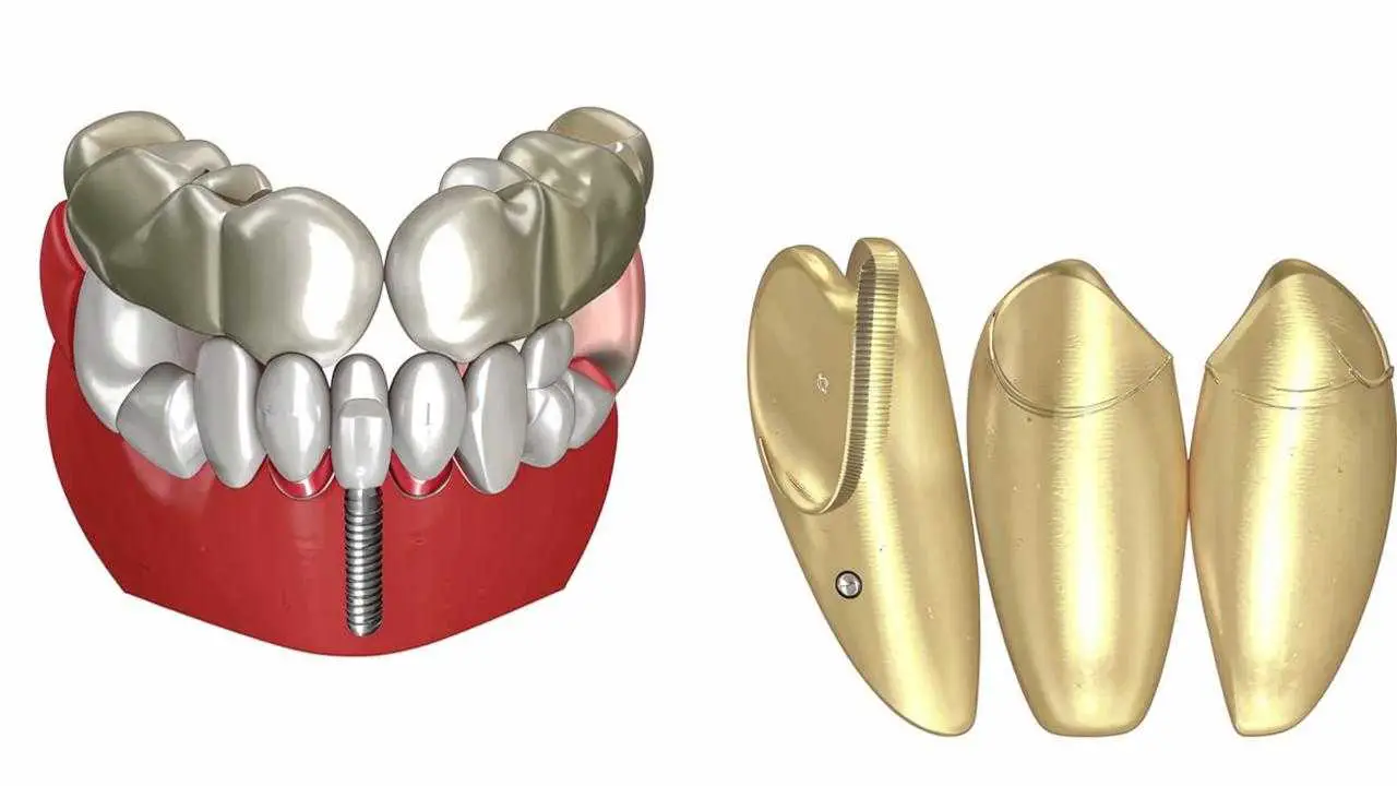 Dental inlays and posts