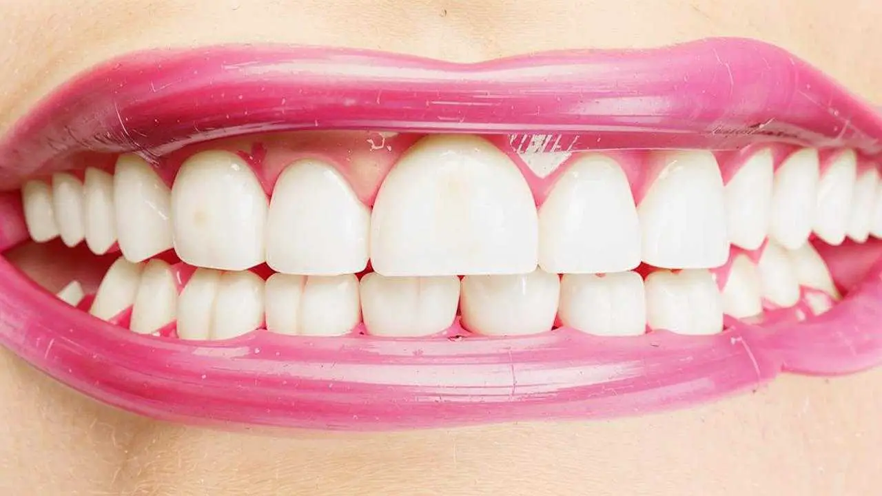 types of whitening in dentistry