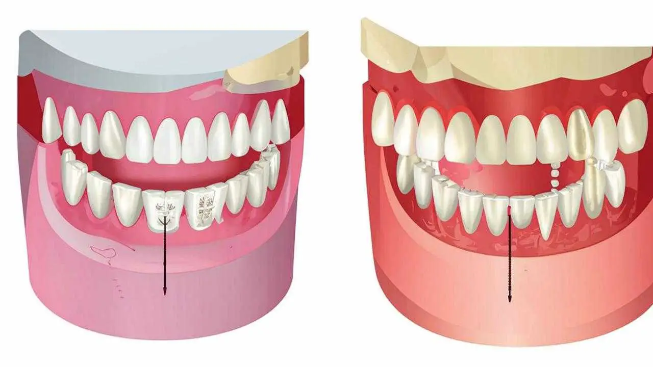 Cement and screw fixation of the dental bridge