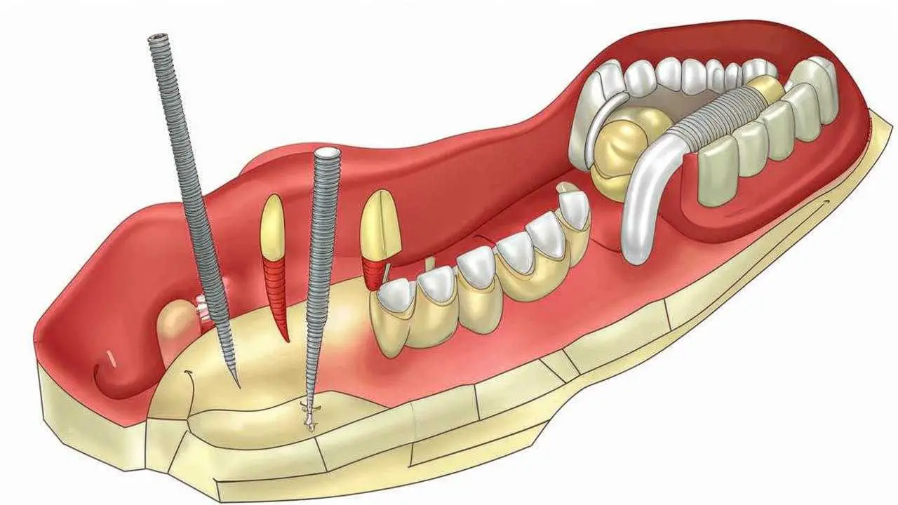 Zygoma implants: features and alternatives