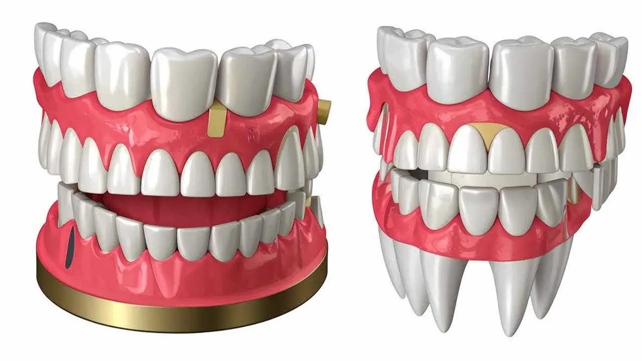 Zygoma implant prosthetic options