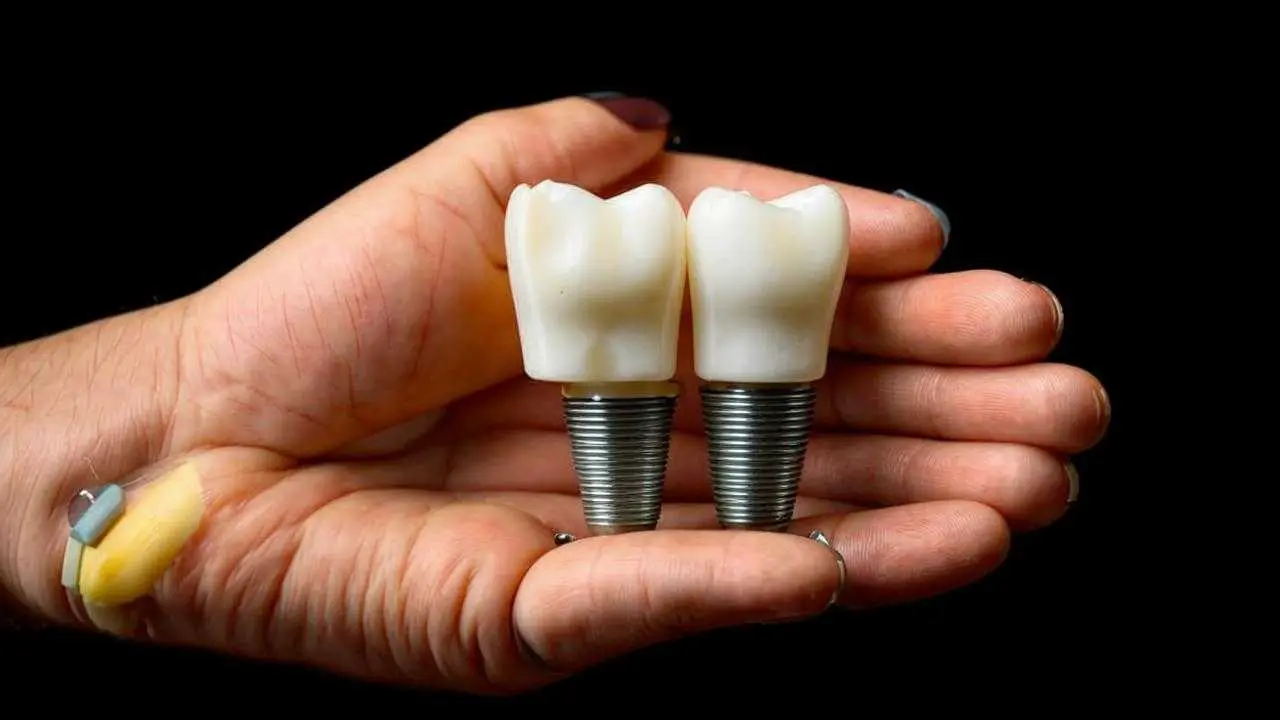 Dental Implants - Placement Process and Lifespan