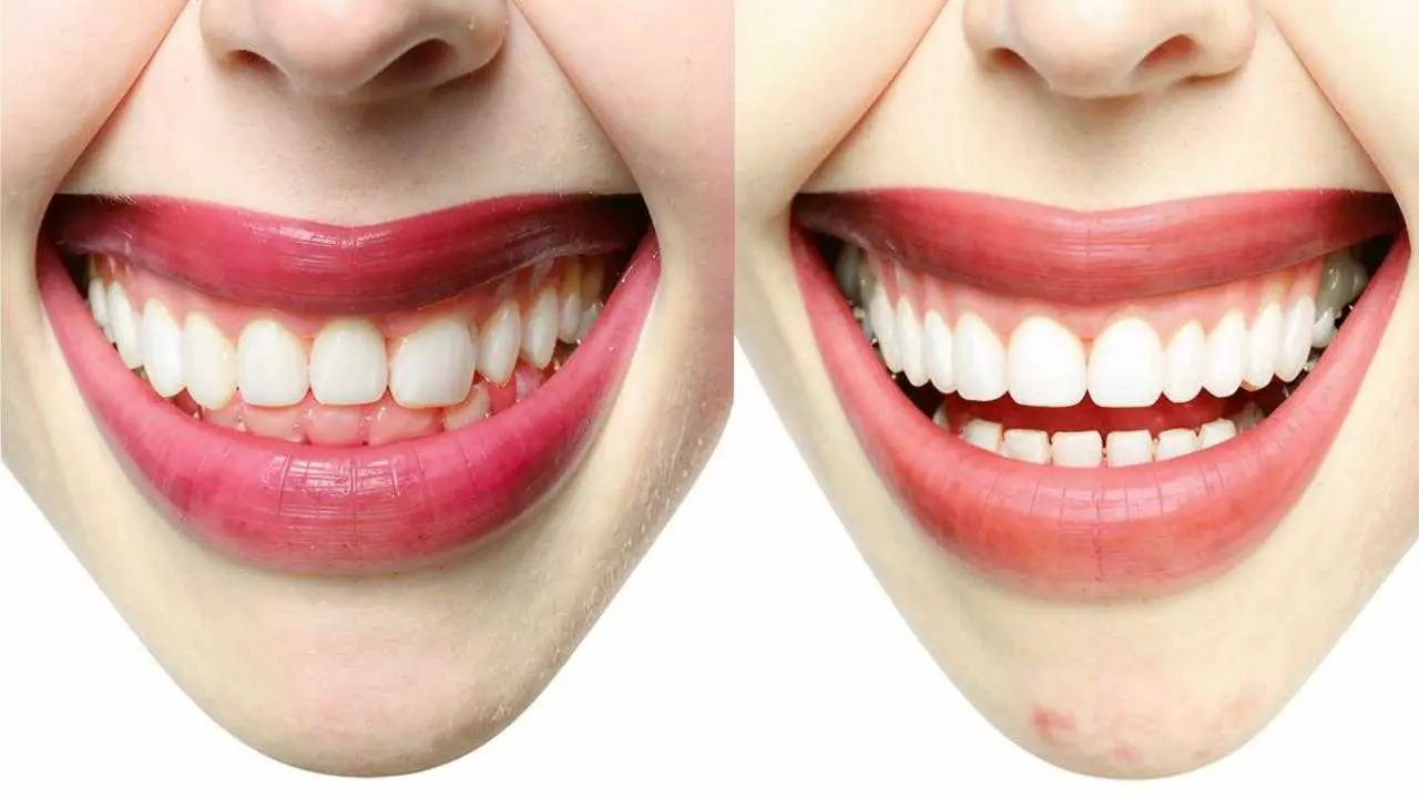 before-and-after photos of braces