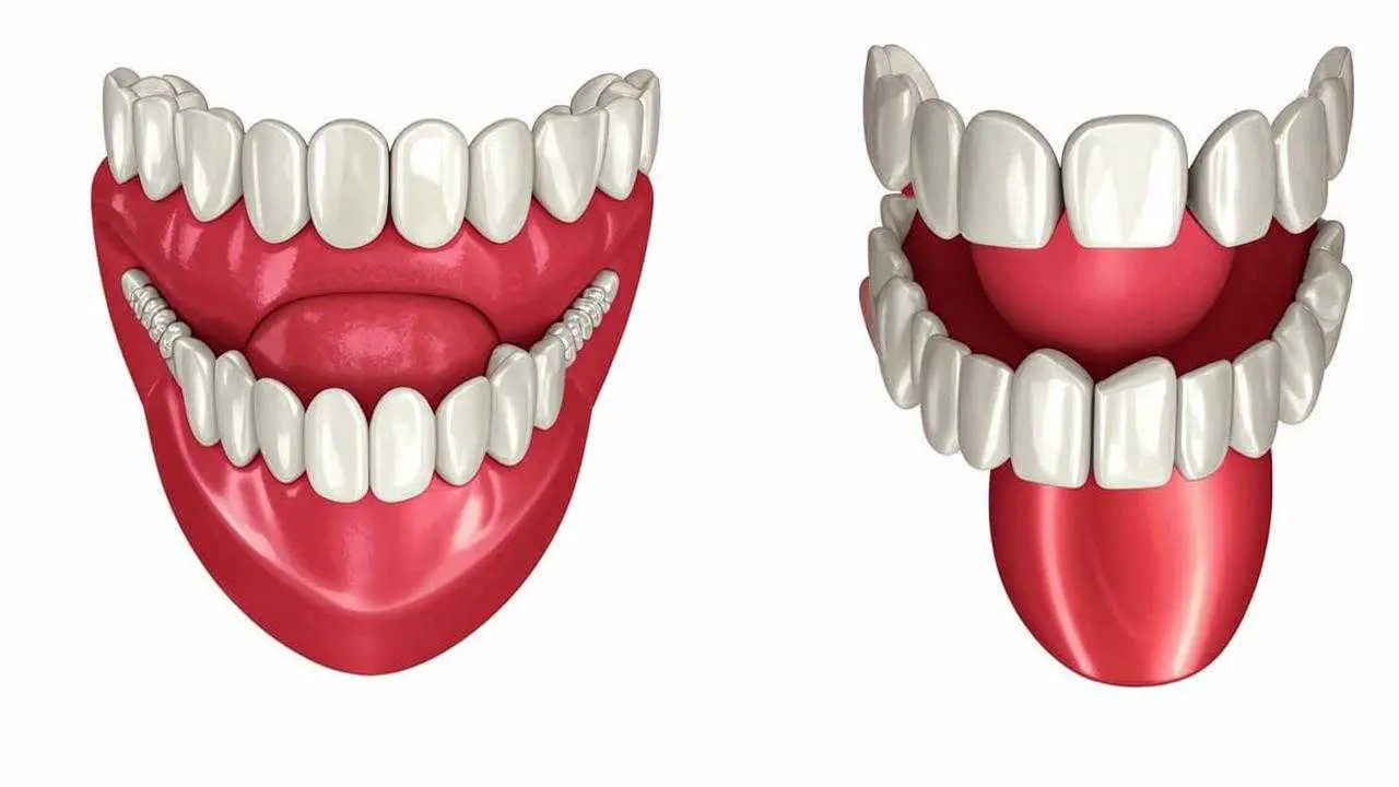 palate- and palate-less dentures