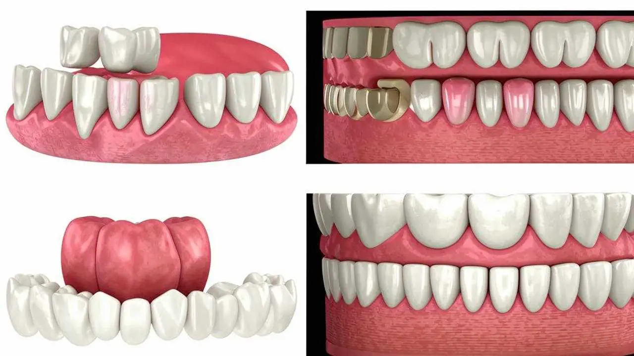 dental crown materials