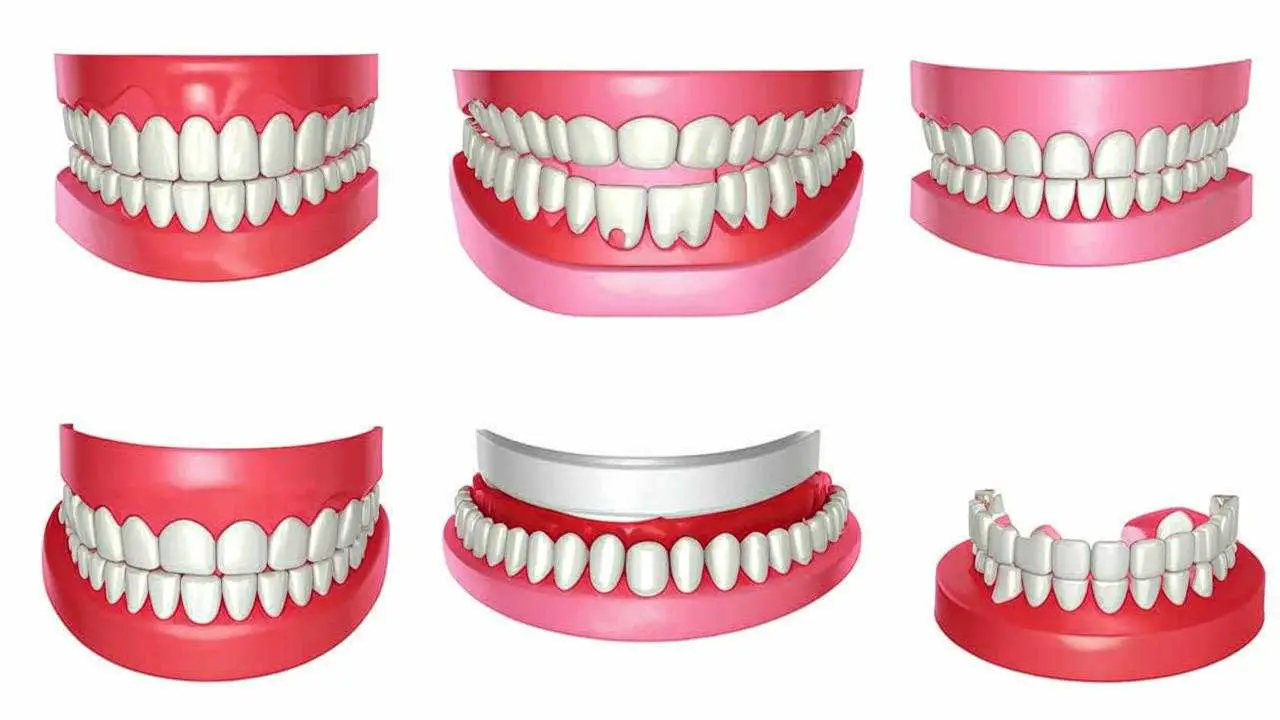 types of removable upper dentures