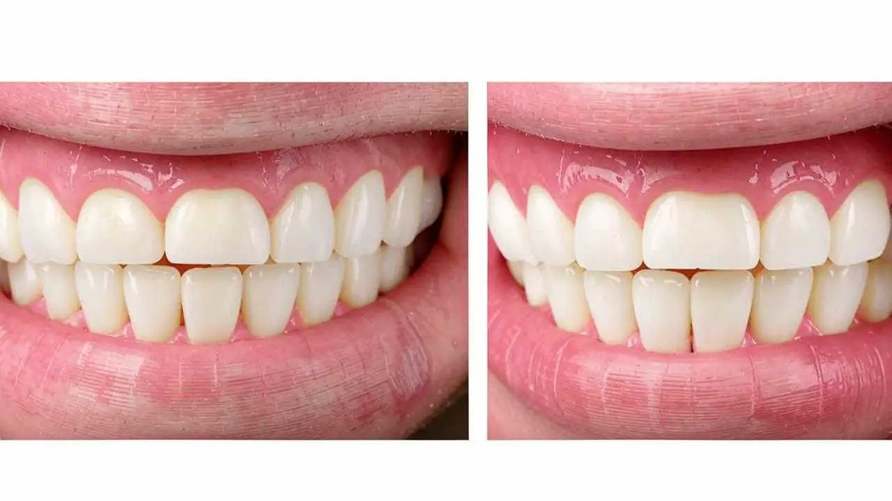 composite and ceramic veneers