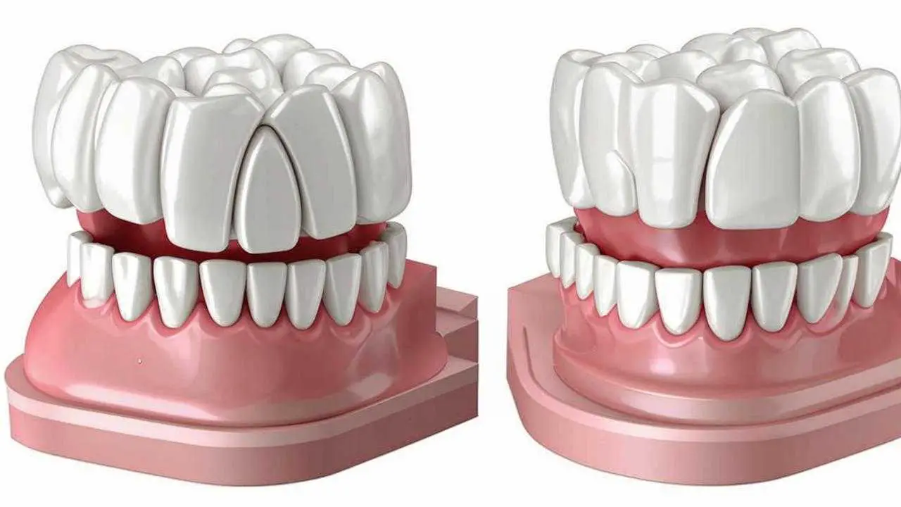 Cement and screw fixation of the dental bridge