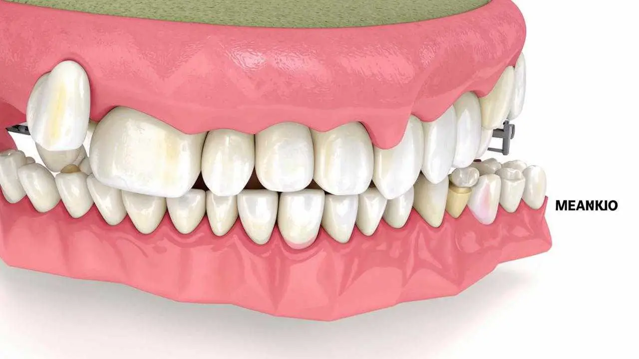 Differences between metal and ceramic crowns