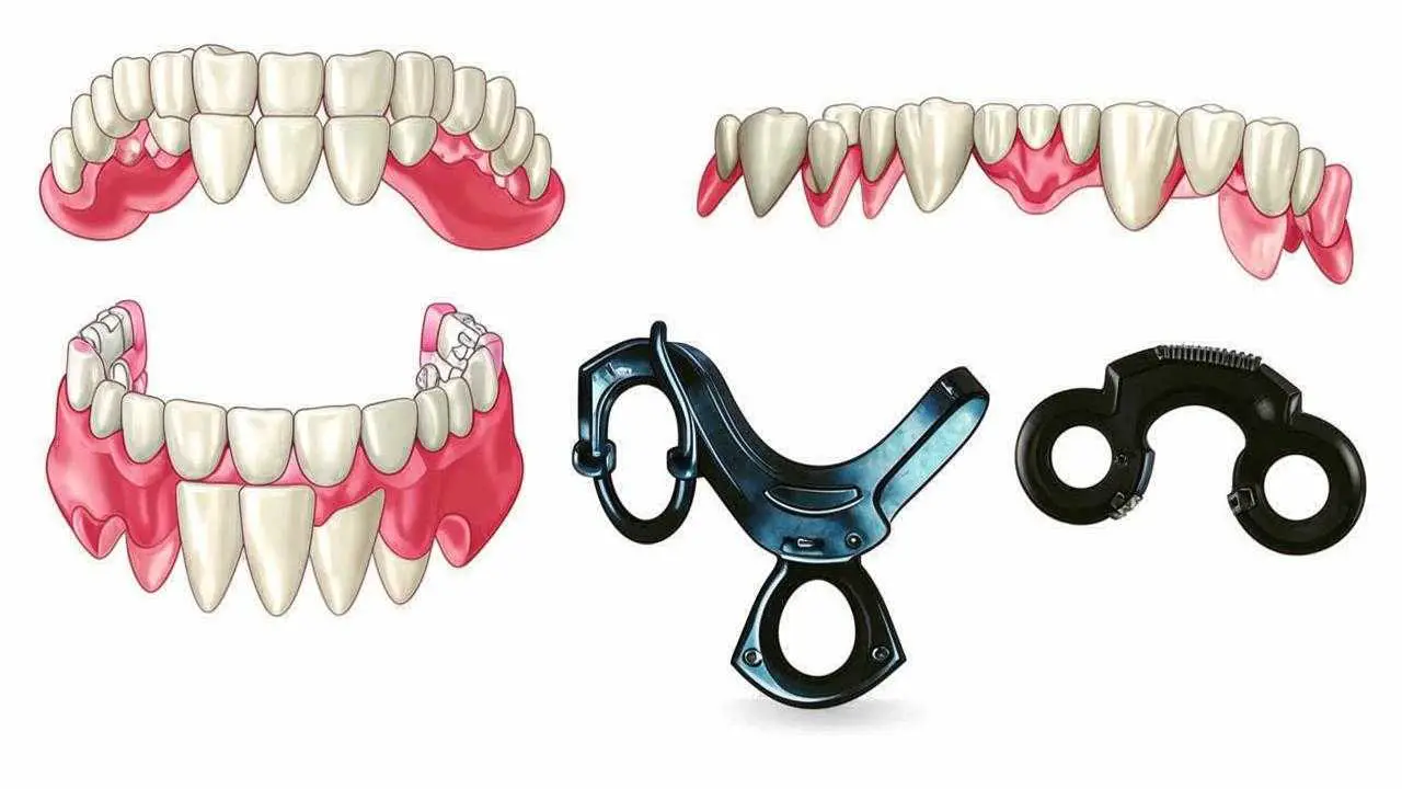 bracket retention