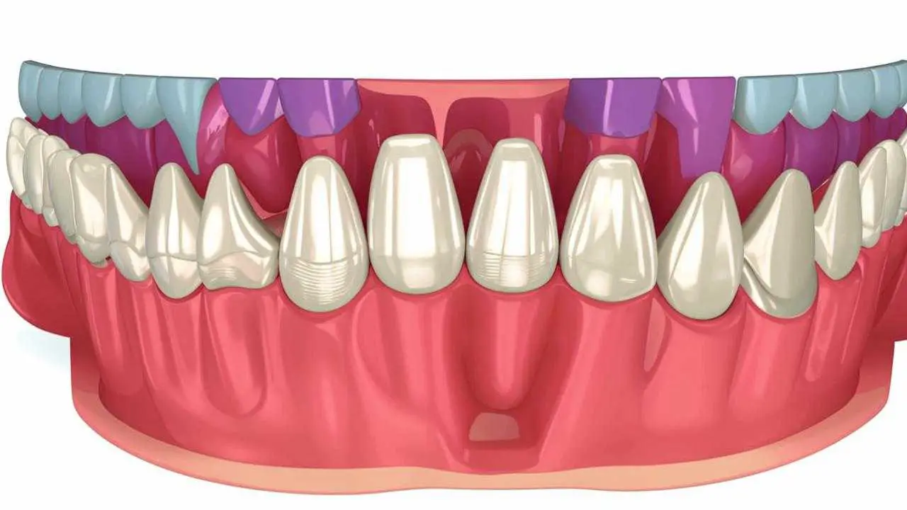 secondary caries under a filling