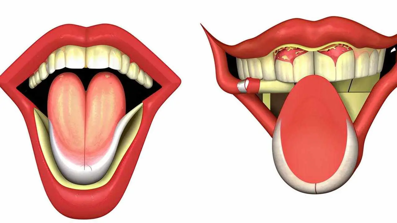 catarrhal glossitis of the tongue