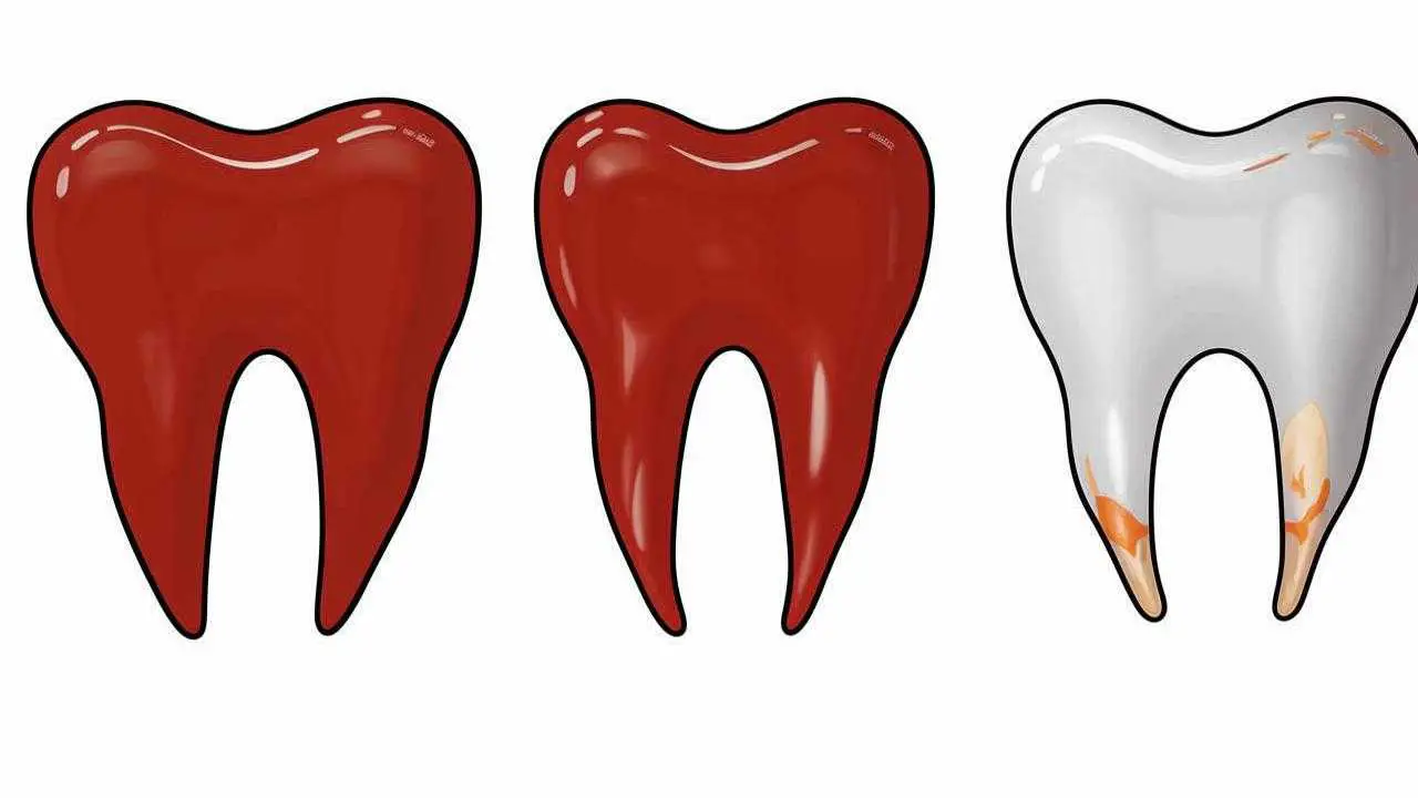 gingivitis and periodontal disease