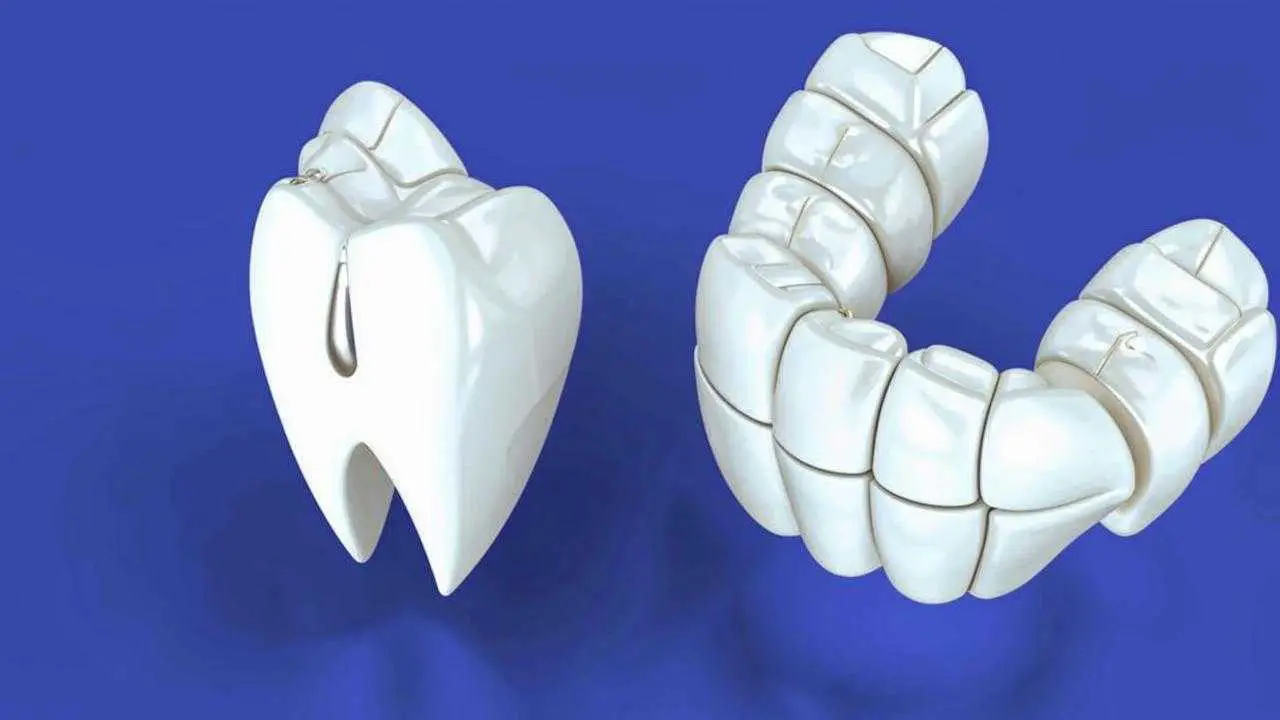 zirconia bridge