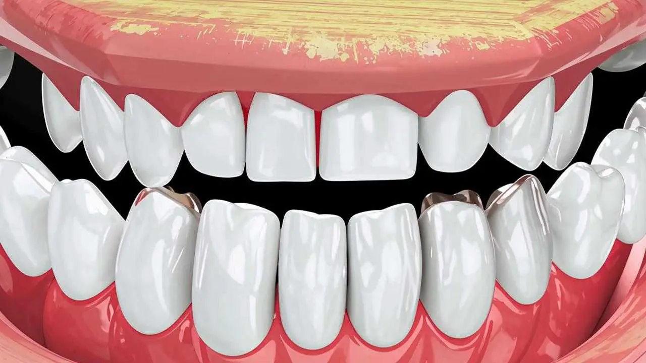 composite veneers