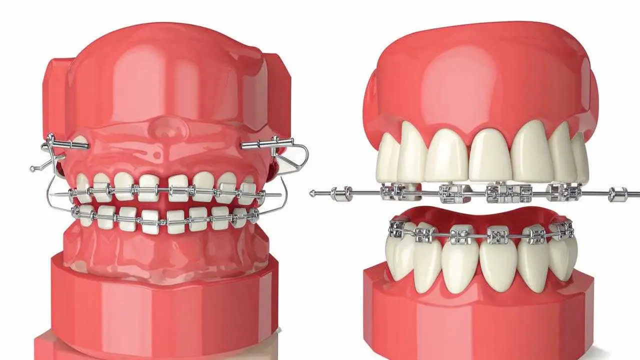 Ligature and ligatureless braces