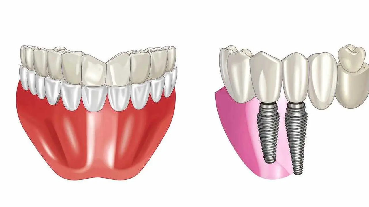 dental bridges and implants