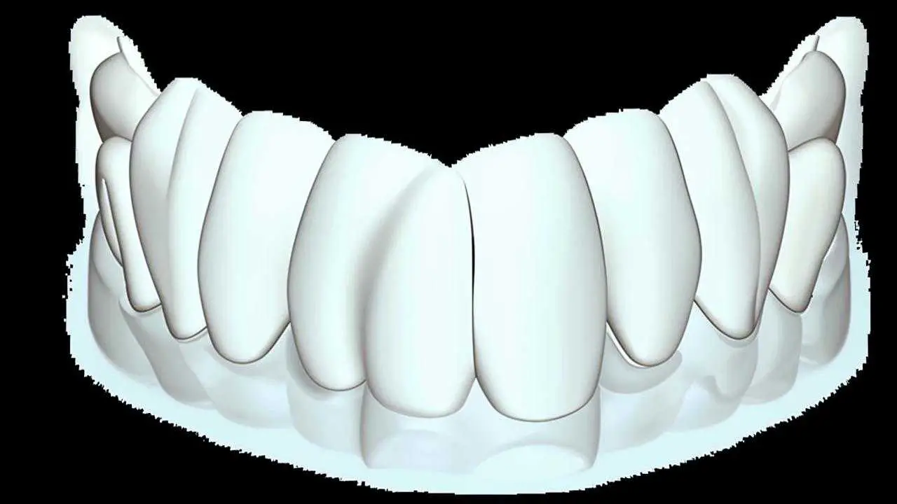 all-ceramic crowns