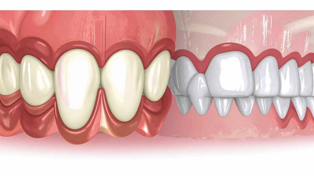 Periodontal pocket and gingival recession