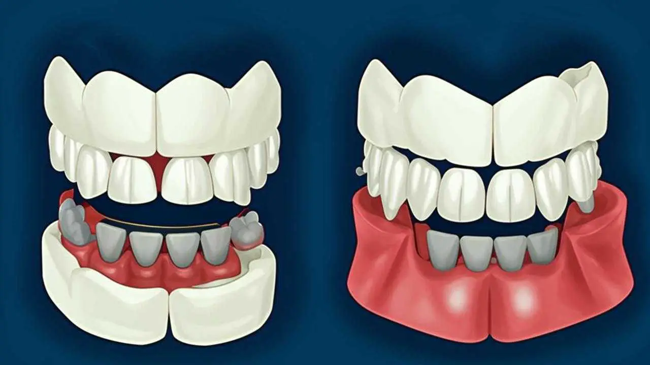 anterior and lateral open bite