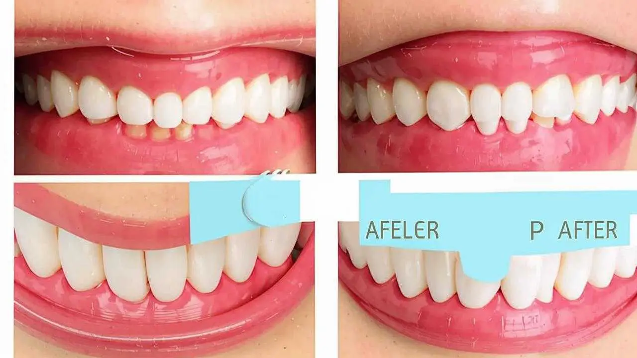 Before and after photos of veneers at ROOTT