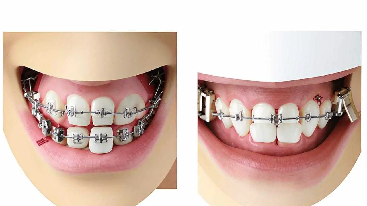 differences between eliners and braces