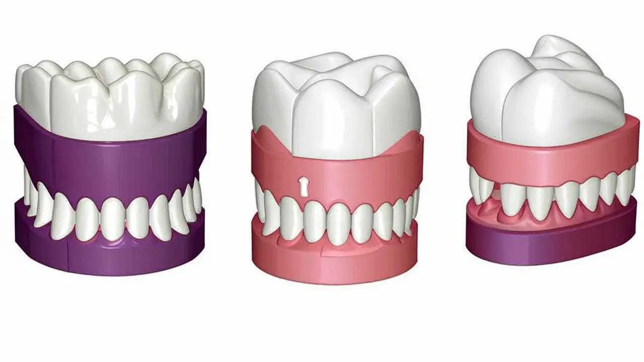 partial dentures