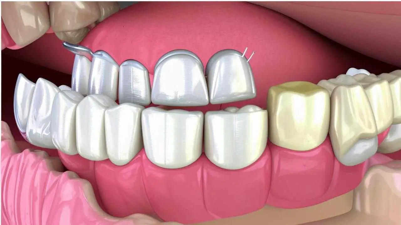 butterfly denture for front teeth