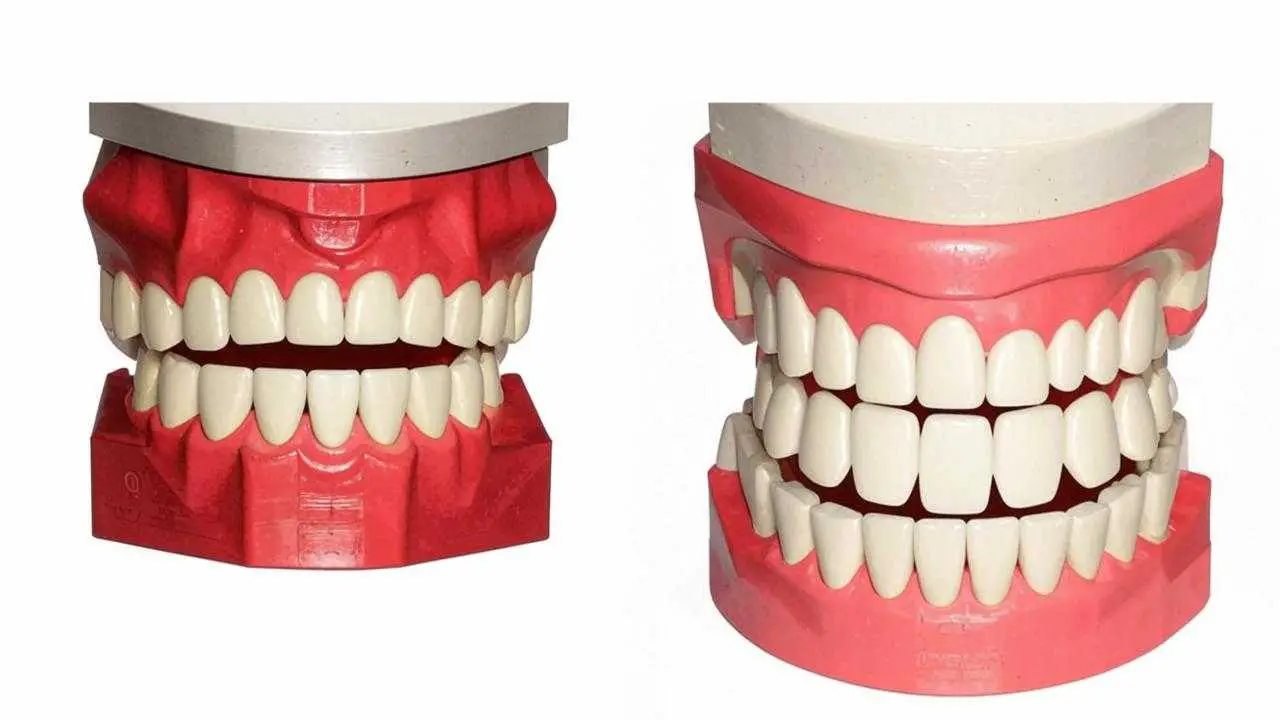 full and partial nylon dentures