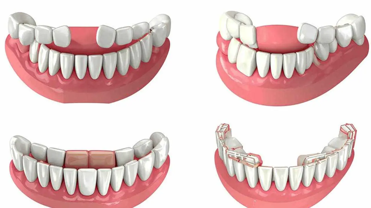 dental bridge