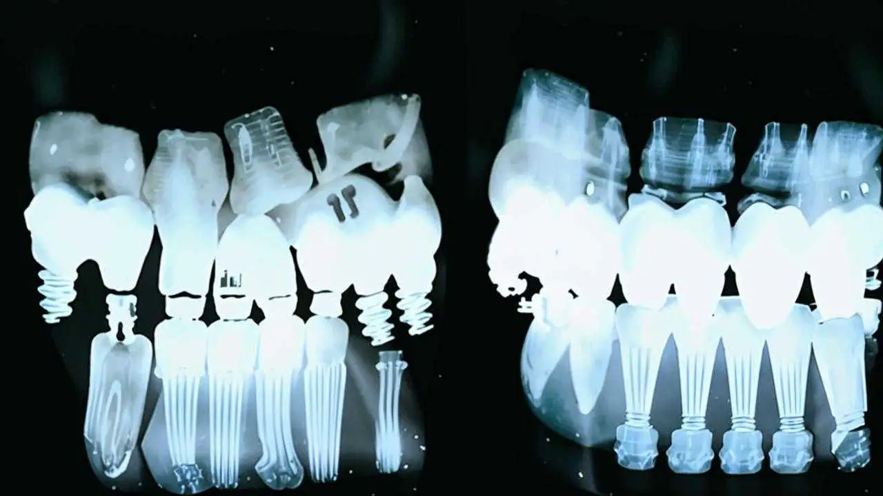 peri-implantitis on x-ray