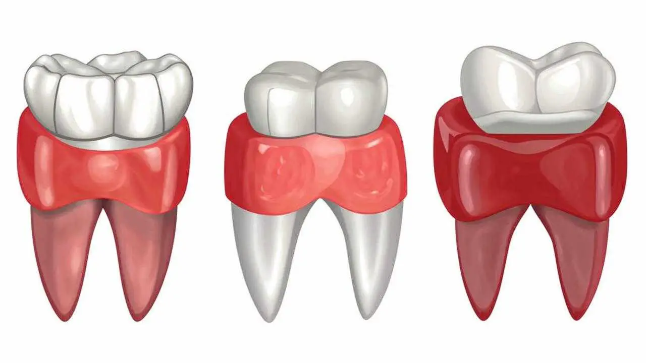 alternatives to dental implants