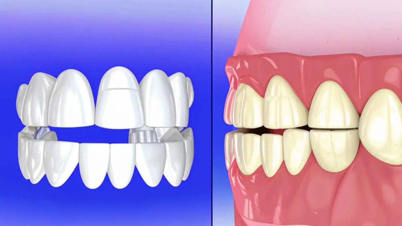 dental bridges and implants