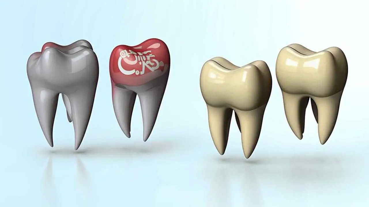 Dental inlays and posts