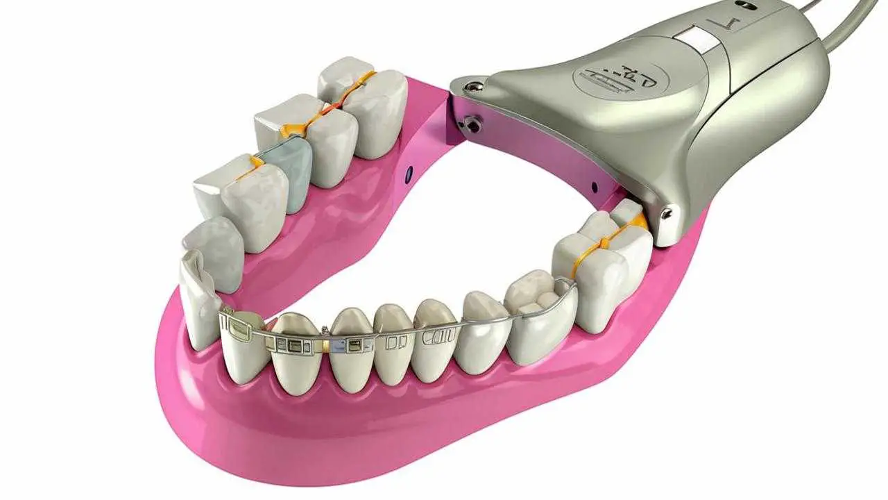 splinting bracket