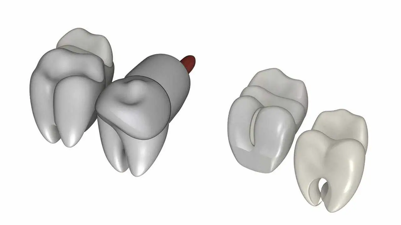 Dental inlays and posts