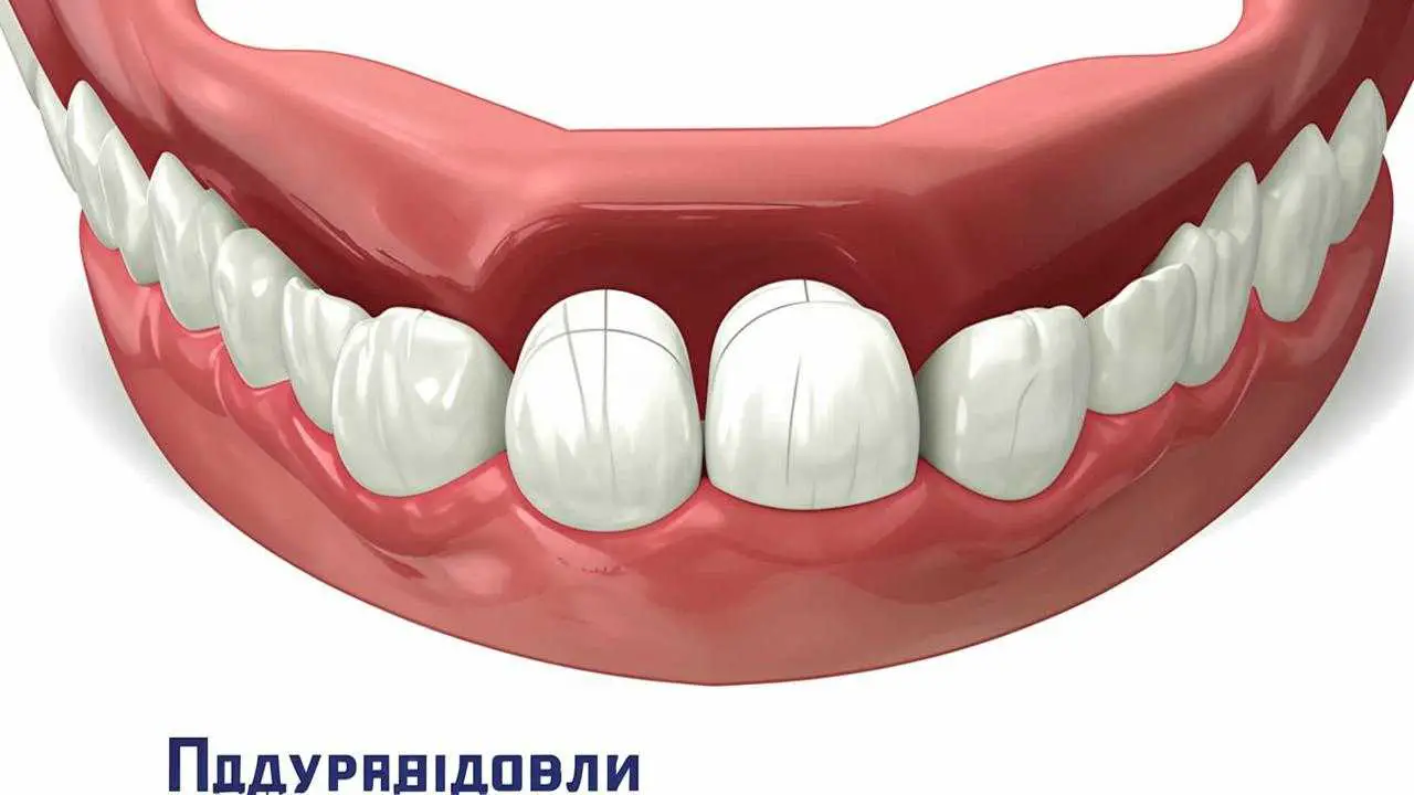 tooth misalignment after extraction