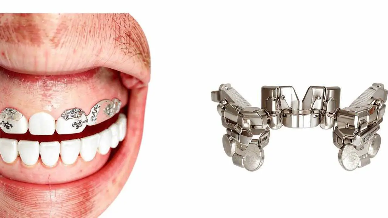 differences between eliners and braces