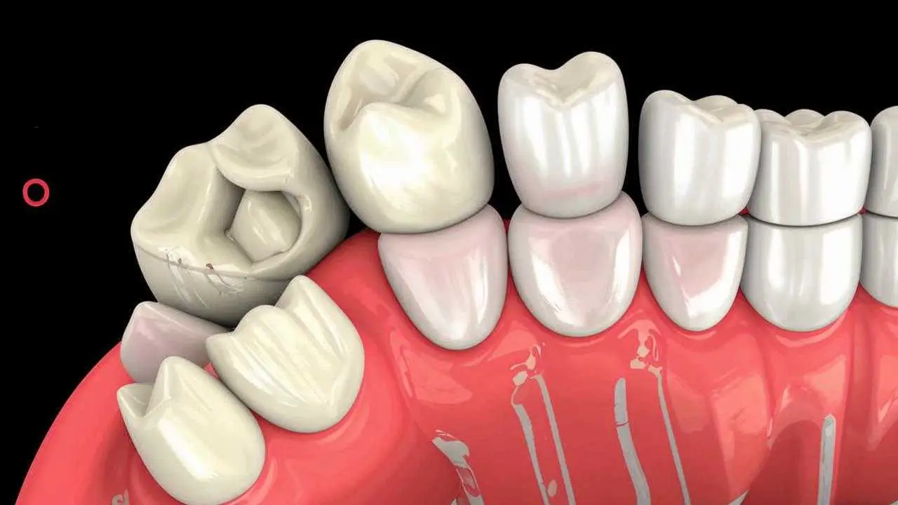 fistula under the tooth